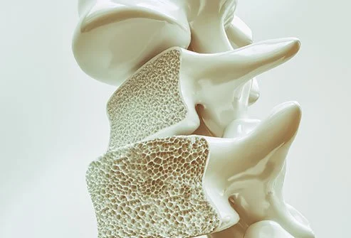 Osteoporosis bone loss